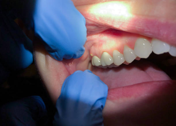 Best Root Canal Emergency Dentist  in Hughestown, PA